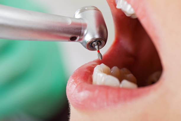 Best Emergency Root Canal Treatment in Sandia Heights, NM
